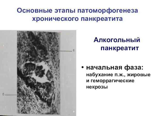 Основные этапы патоморфогенеза хронического панкреатита Алкогольный панкреатит начальная фаза: набухание п.ж., жировые и геморрагические некрозы