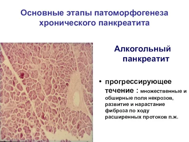 Основные этапы патоморфогенеза хронического панкреатита Алкогольный панкреатит прогрессирующее течение : множественные