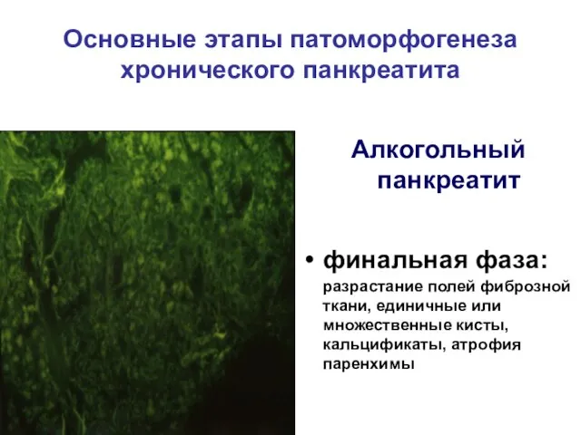 Основные этапы патоморфогенеза хронического панкреатита Алкогольный панкреатит финальная фаза: разрастание полей