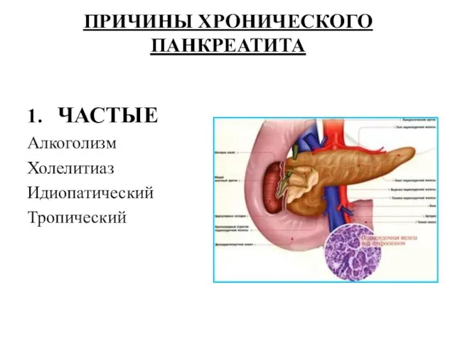 ПРИЧИНЫ ХРОНИЧЕСКОГО ПАНКРЕАТИТА 1. ЧАСТЫЕ Алкоголизм Холелитиаз Идиопатический Тропический