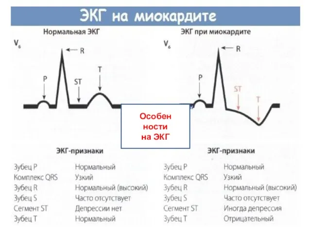 Особен ности на ЭКГ