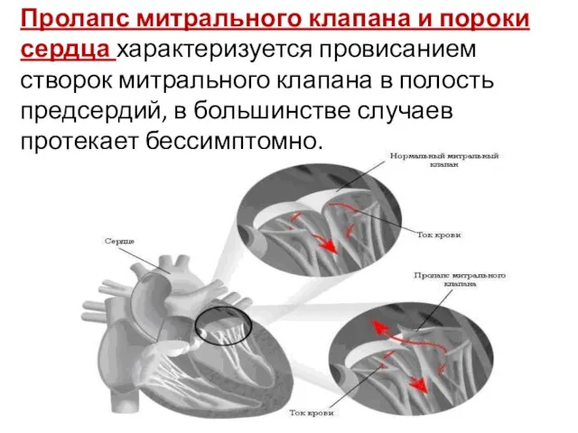 Пролапс митрального клапана и пороки сердца характеризуется провисанием створок митрального клапана