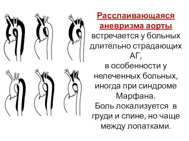 Расслаивающаяся аневризма аорты встречается у больных длительно страдающих АГ, в особенности