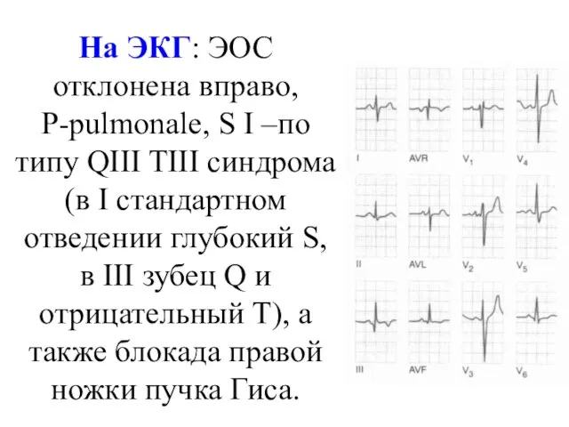 На ЭКГ: ЭОС отклонена вправо, Р-pulmonale, S I –по типу QIII