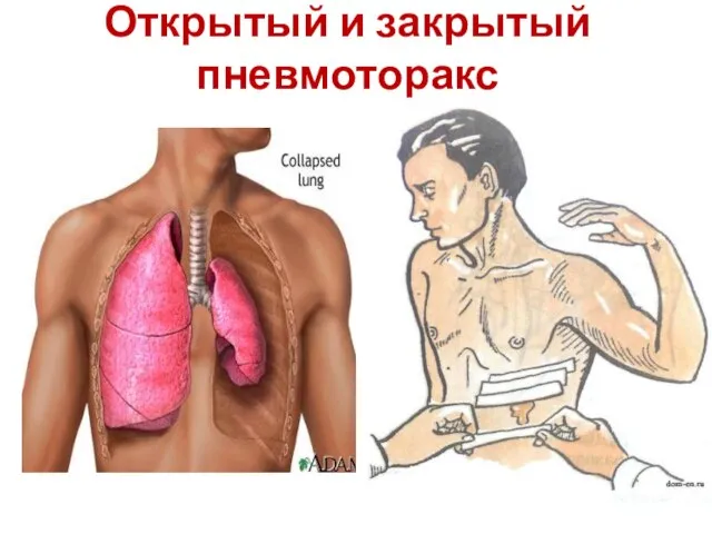 Открытый и закрытый пневмоторакс