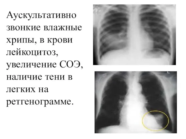 Аускультативно звонкие влажные хрипы, в крови лейкоцитоз, увеличение СОЭ, наличие тени в легких на ретгенограмме.