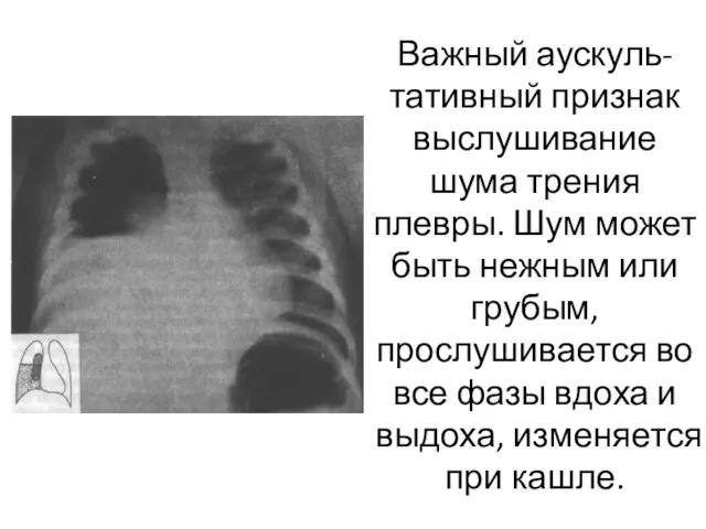 Важный аускуль-тативный признак выслушивание шума трения плевры. Шум может быть нежным