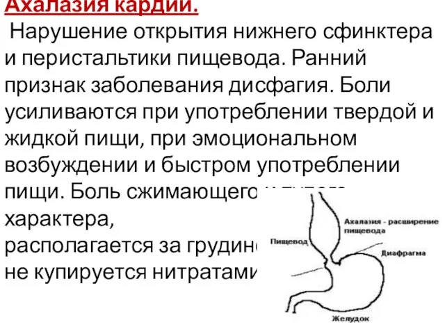 Ахалазия кардии. Нарушение открытия нижнего сфинктера и перистальтики пищевода. Ранний признак