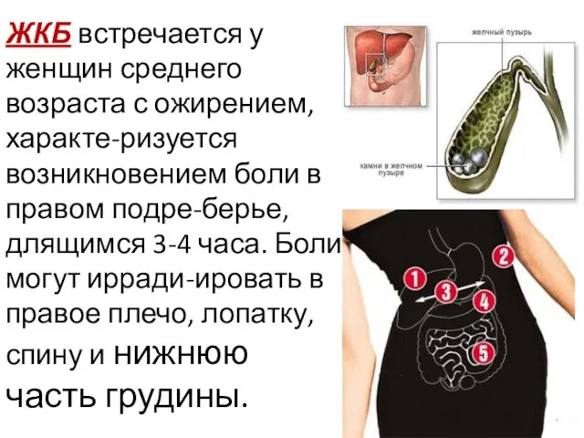 ЖКБ встречается у женщин среднего возраста с ожирением, характе-ризуется возникновением боли