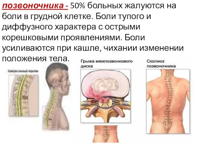 Остеохондроз шейного отдела позвоночника - 50% больных жалуются на боли в