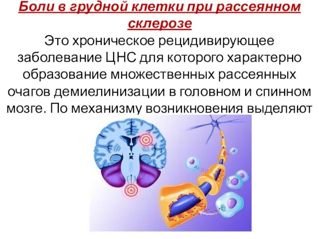 Боли в грудной клетки при рассеянном склерозе Это хроническое рецидивирующее заболевание