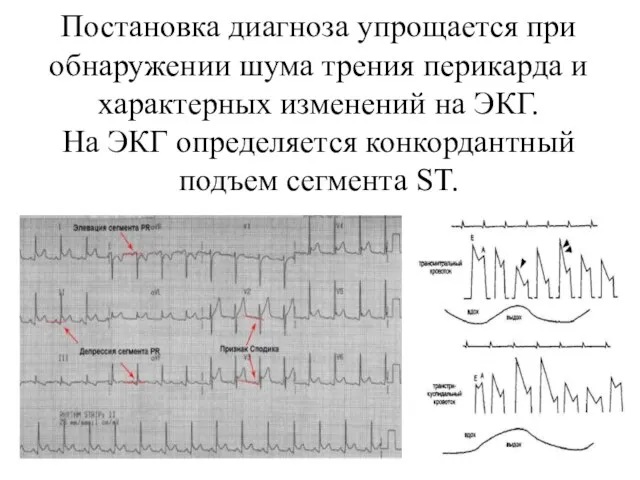 Постановка диагноза упрощается при обнаружении шума трения перикарда и характерных изменений