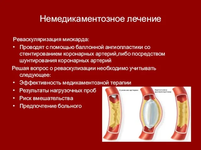 Немедикаментозное лечение Реваскуляризация миокарда: Проводят с помощью баллонной ангиопластики со стентированием