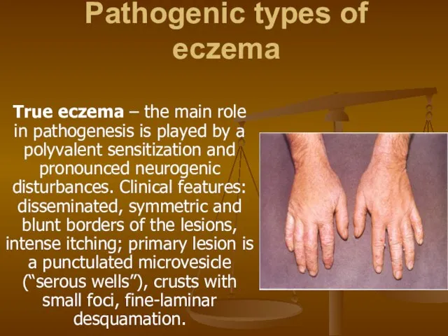 Pathogenic types of eczema True eczema – the main role in