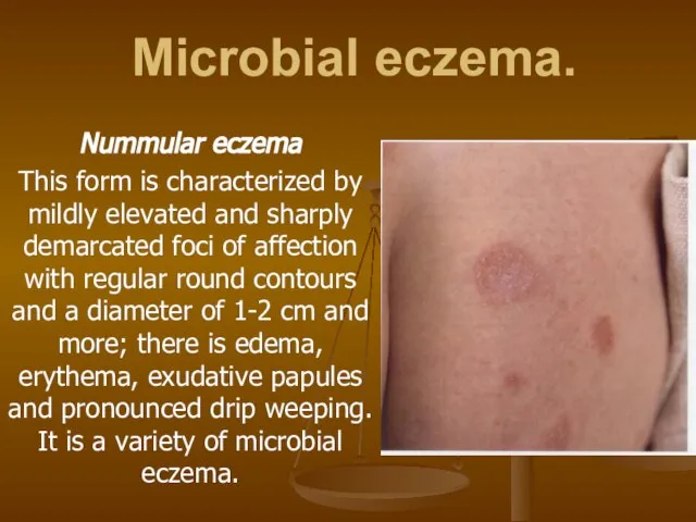 Microbial eczema. Nummular eczema This form is characterized by mildly elevated