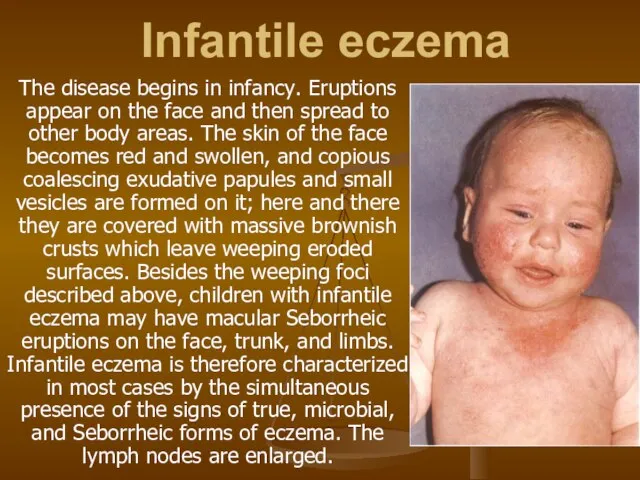 Infantile eczema The disease begins in infancy. Eruptions appear on the