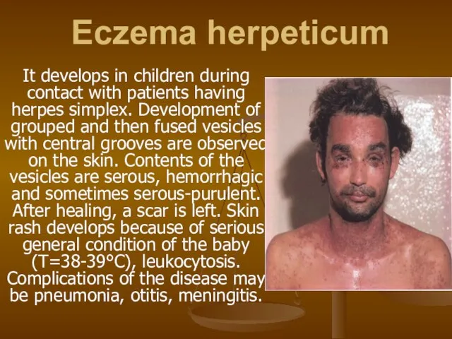 Eczema herpeticum It develops in children during contact with patients having