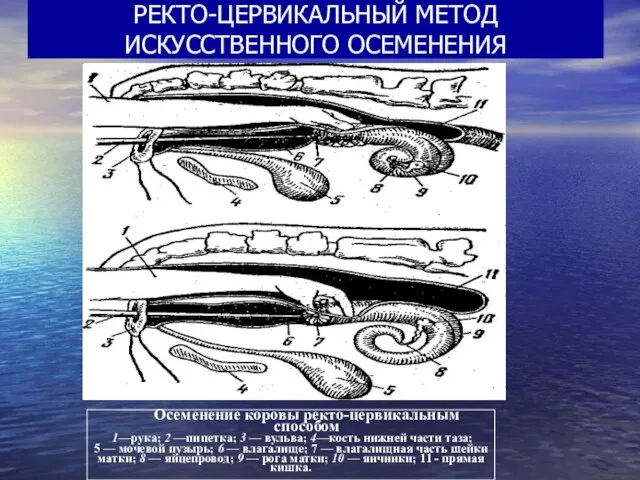 РЕКТО-ЦЕРВИКАЛЬНЫЙ МЕТОД ИСКУССТВЕННОГО ОСЕМЕНЕНИЯ