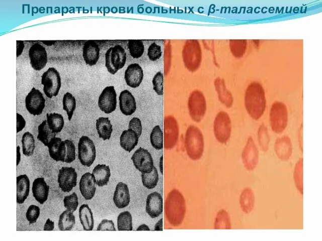 Препараты крови больных с β-талассемией