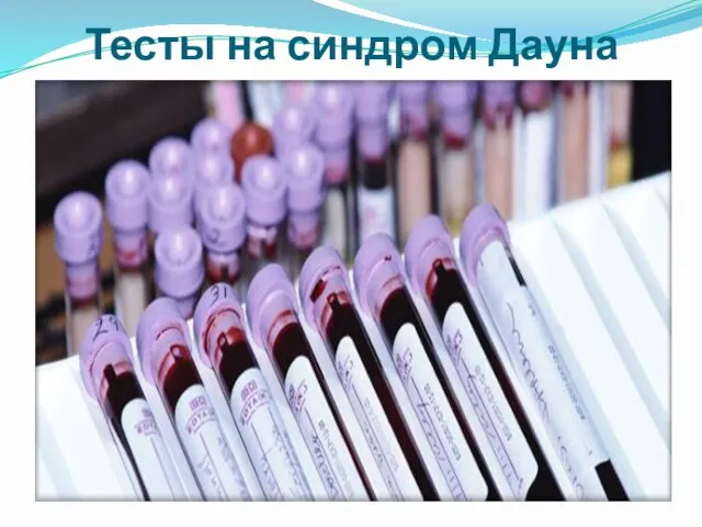 Тесты на синдром Дауна