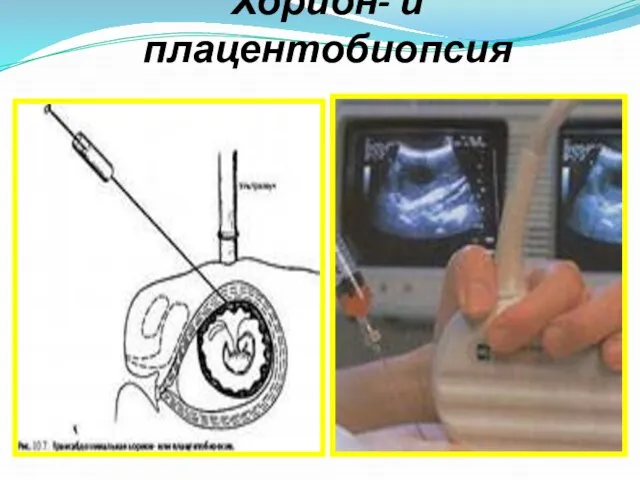 Хорион- и плацентобиопсия