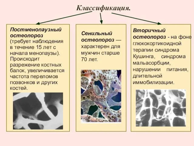 Вторичный остеопороз - на фоне глюкокортикоидной терапии синдрома Кушинга, синдрома мальасорбции,