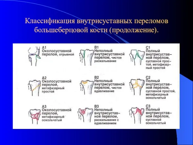 Классификация внутрисуставных переломов большеберцовой кости (продолжение).