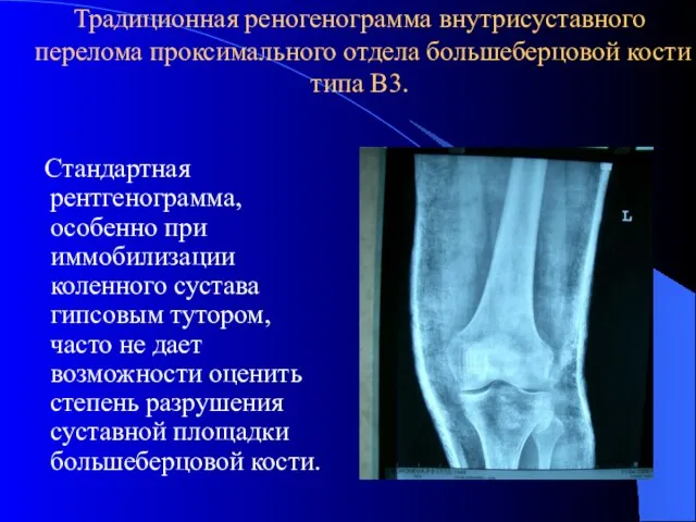 Традиционная реногенограмма внутрисуставного перелома проксимального отдела большеберцовой кости типа В3. Стандартная