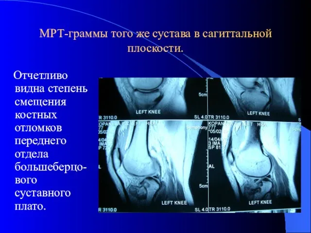 МРТ-граммы того же сустава в сагиттальной плоскости. Отчетливо видна степень смещения