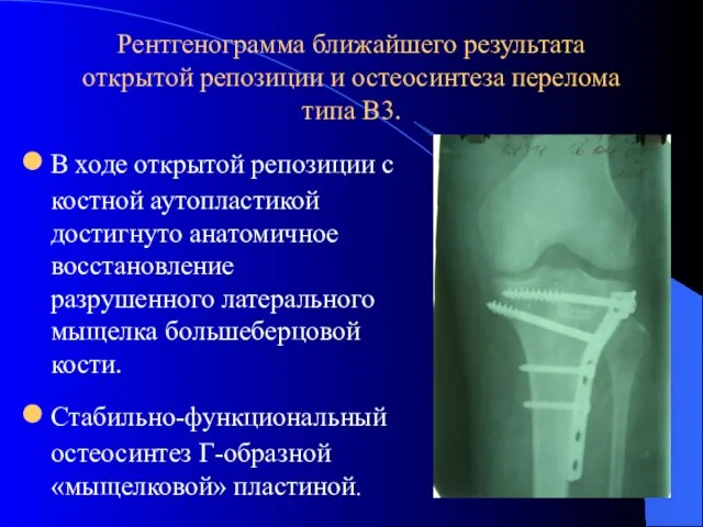 Рентгенограмма ближайшего результата открытой репозиции и остеосинтеза перелома типа В3. В