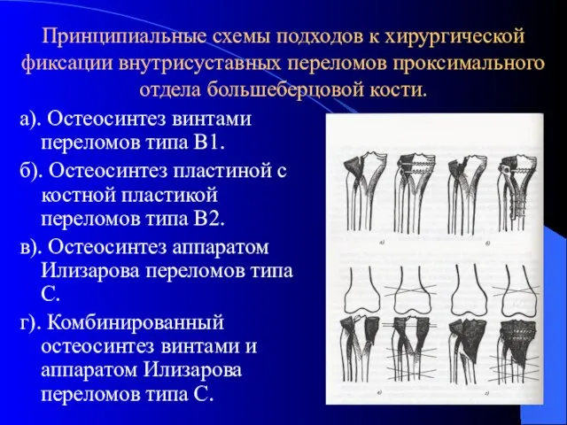 Принципиальные схемы подходов к хирургической фиксации внутрисуставных переломов проксимального отдела большеберцовой