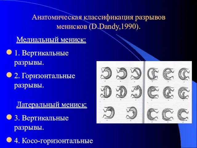 Анатомическая классификация разрывов менисков (D.Dandy,1990). Медиальный мениск: 1. Вертикальные разрывы. 2.