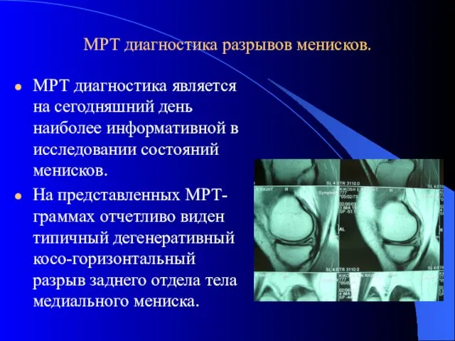 МРТ диагностика разрывов менисков. МРТ диагностика является на сегодняшний день наиболее