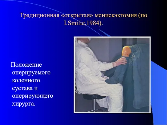 Традиционная «открытая» менискэктомия (по I.Smilie,1984). Положение оперируемого коленного сустава и оперирующего хирурга.