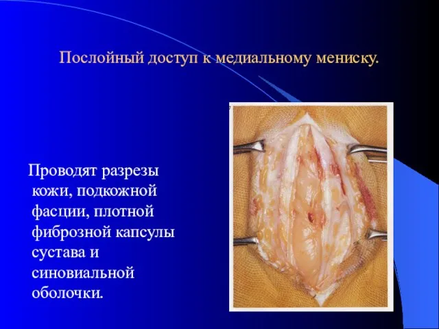 Послойный доступ к медиальному мениску. Проводят разрезы кожи, подкожной фасции, плотной