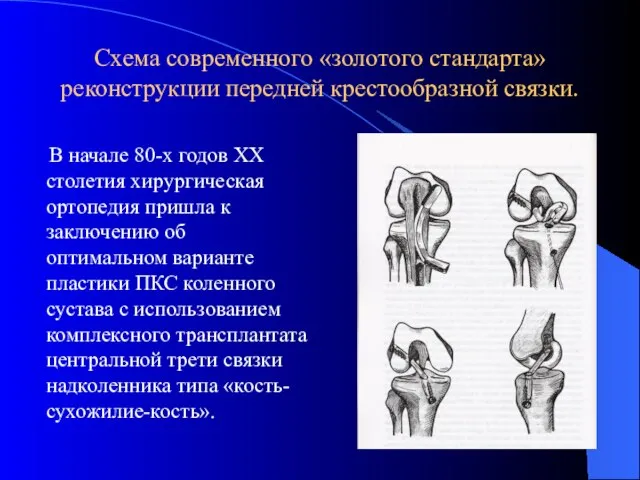 Схема современного «золотого стандарта» реконструкции передней крестообразной связки. В начале 80-х