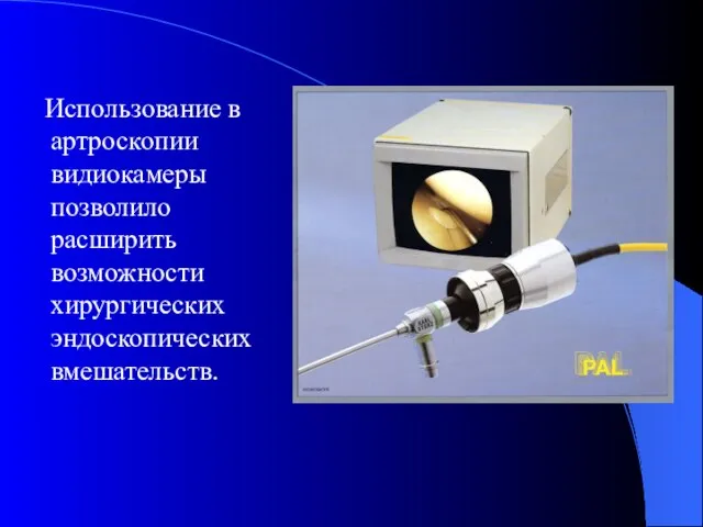 Использование в артроскопии видиокамеры позволило расширить возможности хирургических эндоскопических вмешательств.