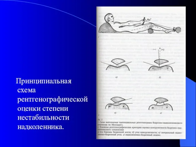 Принципиальная схема рентгенографической оценки степени нестабильности надколенника.