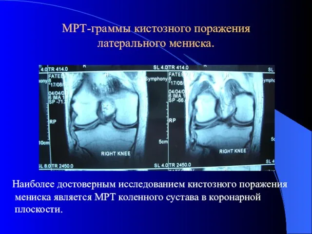 МРТ-граммы кистозного поражения латерального мениска. Наиболее достоверным исследованием кистозного поражения мениска