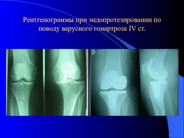 Рентгенограммы при эндопротезировании по поводу варусного гонартроза IV ст.