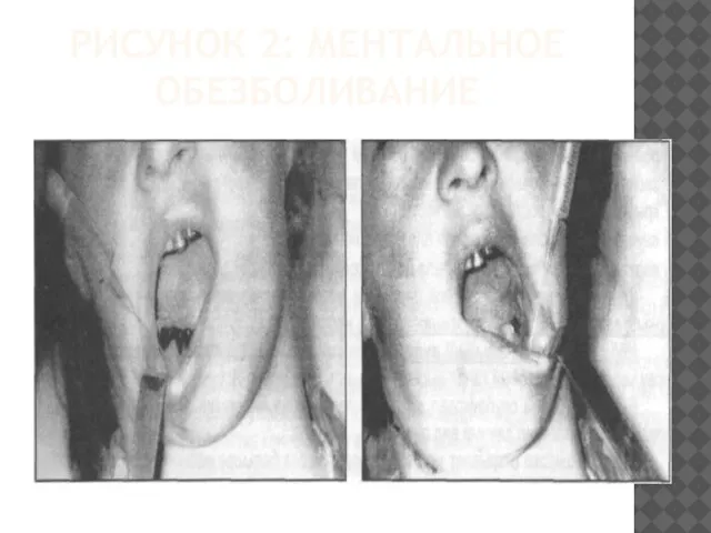 РИСУНОК 2: МЕНТАЛЬНОЕ ОБЕЗБОЛИВАНИЕ