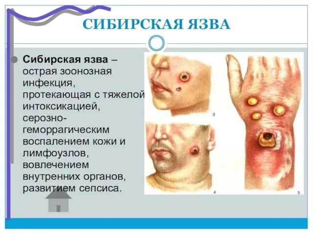 СИБИРСКАЯ ЯЗВА Сибирская язва – острая зоонозная инфекция, протекающая с тяжелой