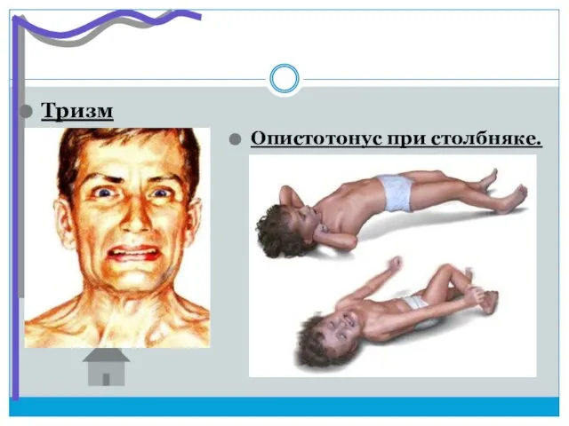 Тризм Опистотонус при столбняке.