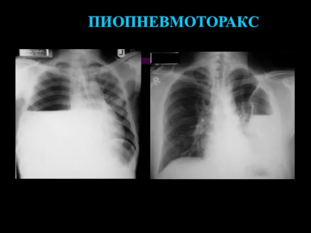 ПИОПНЕВМОТОРАКС