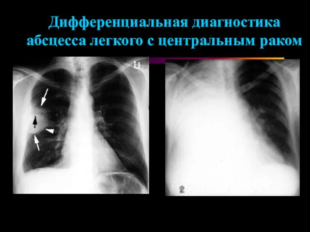 Дифференциальная диагностика абсцесса легкого с центральным раком