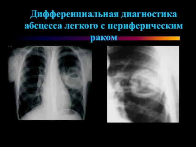 Дифференциальная диагностика абсцесса легкого с периферическим раком