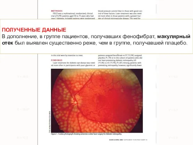 ПОЛУЧЕННЫЕ ДАННЫЕ В дополнение, в группе пациентов, получавших фенофибрат, макулярный отек