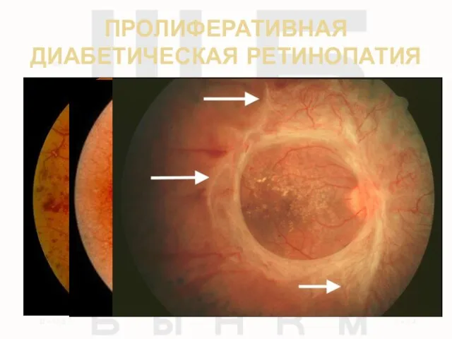 ПРОЛИФЕРАТИВНАЯ ДИАБЕТИЧЕСКАЯ РЕТИНОПАТИЯ