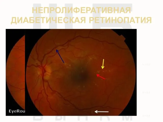 НЕПРОЛИФЕРАТИВНАЯ ДИАБЕТИЧЕСКАЯ РЕТИНОПАТИЯ