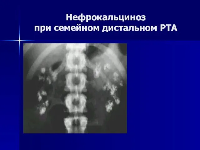 Нефрокальциноз при семейном дистальном РТА